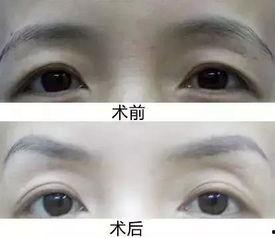 上睑下垂明星,探寻美丽背后的挑战